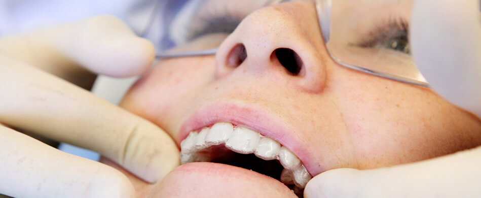 ¿Hay que extraer piezas en la ortodoncia?